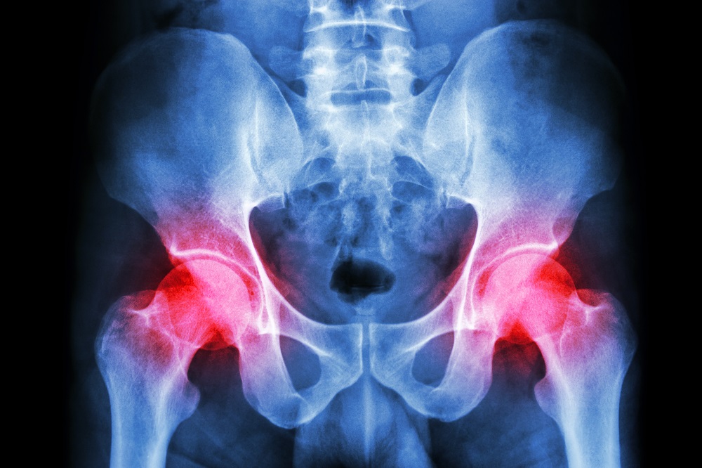 pain in bilateral hips