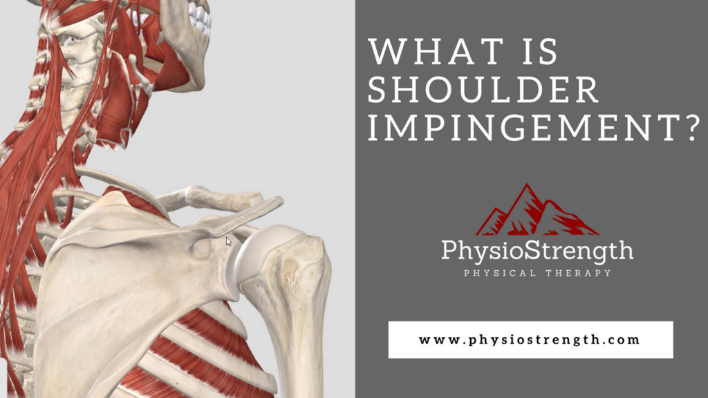 What is Shoulder Impingement