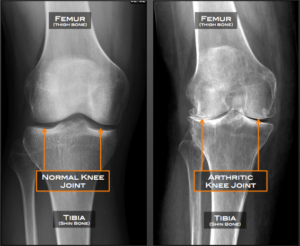 knee x-ray with arthritis