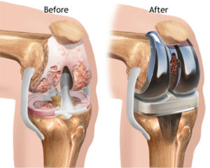 knee replacement before and after