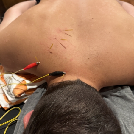 Dry Needling