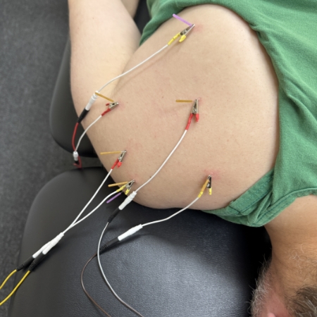 Dry Needling